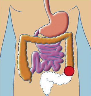 COLOSTOMIES