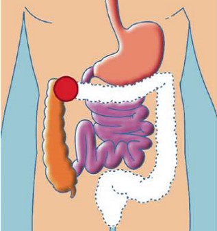 COLOSTOMIES