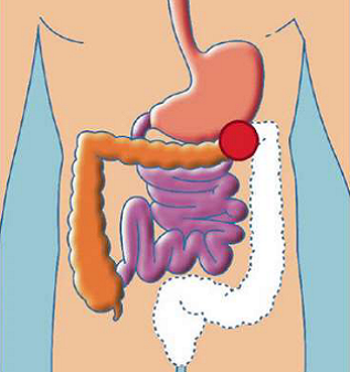 COLOSTOMIES