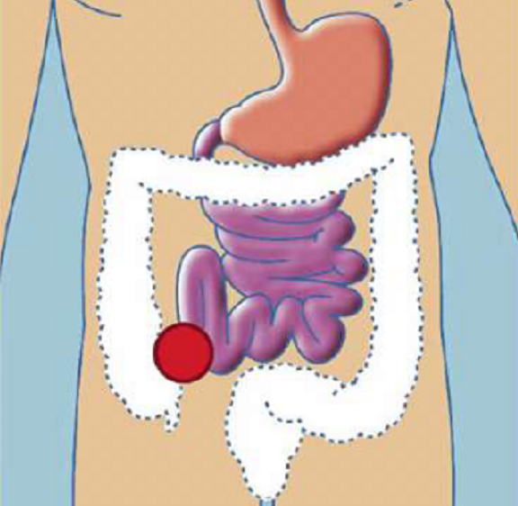 ILEOSTOMIES
