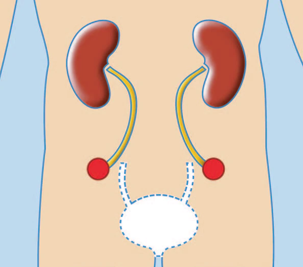 UROSTOMIES