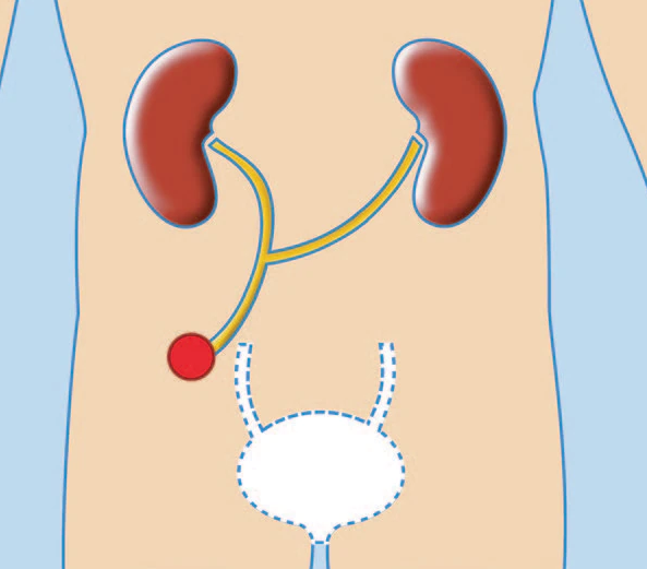 UROSTOMIES