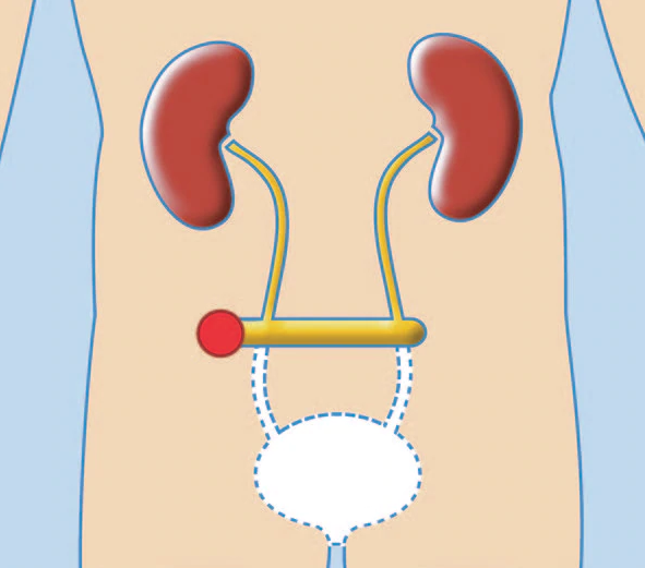 UROSTOMIES